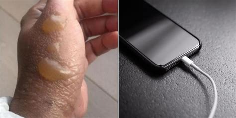 charger exploding girl|Woman suffers burns when her phone charger explodes and sets。